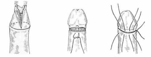 Фимоз у мальчиков