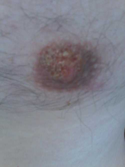 Герпес является вирусным заболеванием, которое может проявляться в виде пузырьков не только на губах, но и на сосках