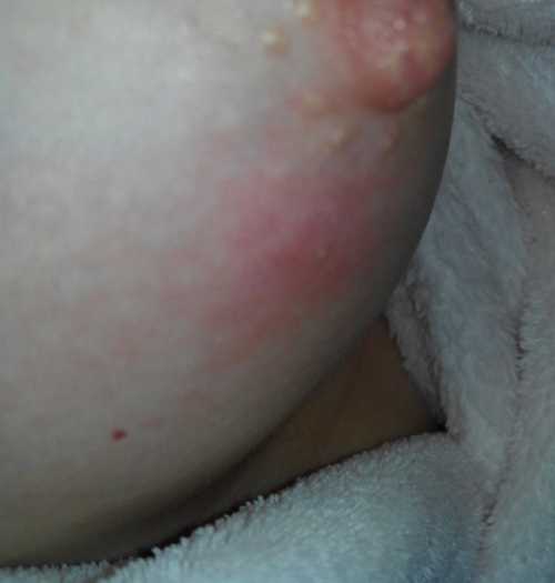 Почему чешутся соски