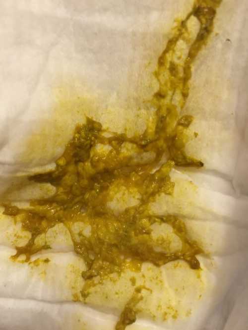 Данное явление называется гипербилирубинемия