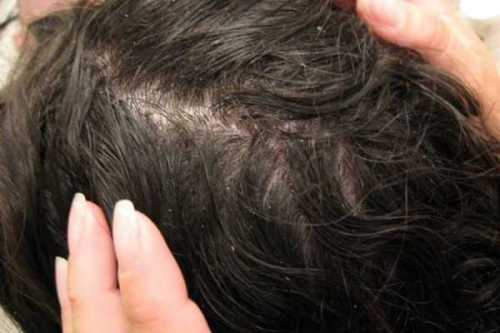 К чему снятся вши