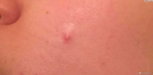 Избавиться от прыща за одну ночь Это возможно