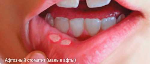 Уход за новорожденным