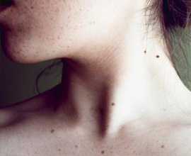 Перерождение родинок в меланому злокачественное образование в большинстве случаев происходит по вине их обладателя