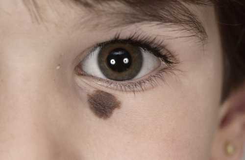 Ученые: долголетие зависит от количества родинок