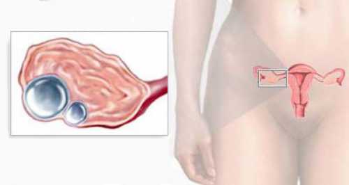 Киста желтого тела правого левого яичника симптомы, лечение, осложнения