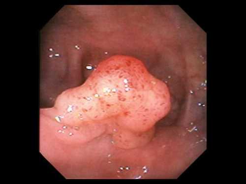 Биопсия полипа при гастроскопии