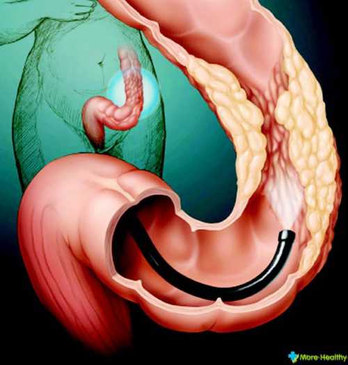 Тактика лечения полипа желудка хирургическая, хотя при небольших размерах и при подтвержденном по результатам биопсии гиперпластиче ском типе опухоли допускается выжидательная тактика и наблюдение за пациентом