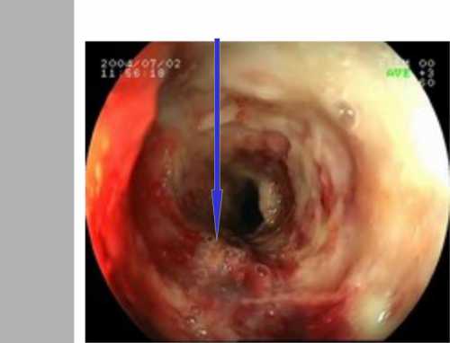 Симптомы неоднозначны, часто ставят специалиста в тупикночной кашель постоянная изжогарези при глотании, в области животаиногда возникает тошнота