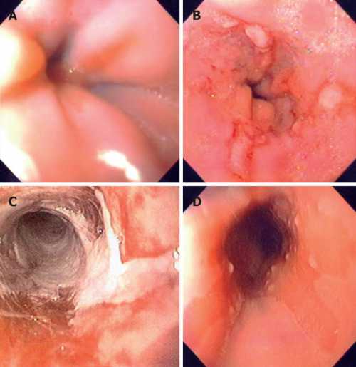 Воспаление пищевода: симптомы, причины, это