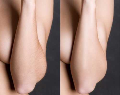 Если у вас волосы имеют темную, густую структуру следует провести удаление