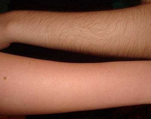 Эпиляция рук воском