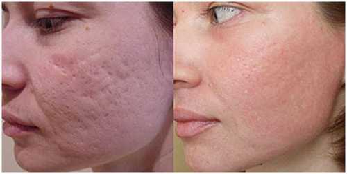 Недовольны состоянием своей кожи Наноперфорация