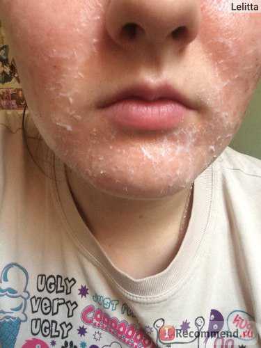 В период грудного вскармливания и на любом сроке беременности процедура не проводится