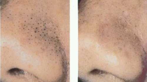 Поскольку в первом разделе были подробно рассмотрены комедоны, что это такое на фото или у себя на лице вы узнаете без труда