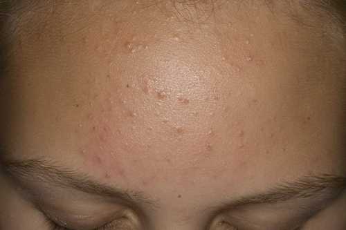 Комедоны на лице