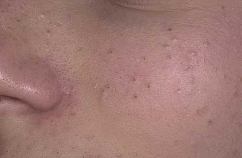 Теперь, если у вас вдруг появятся открытые или закрытые комедоны, причины ухудшения состояния кожи вам известны