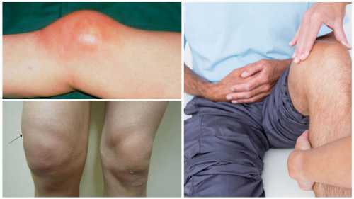 Гемартроз коленного сустава