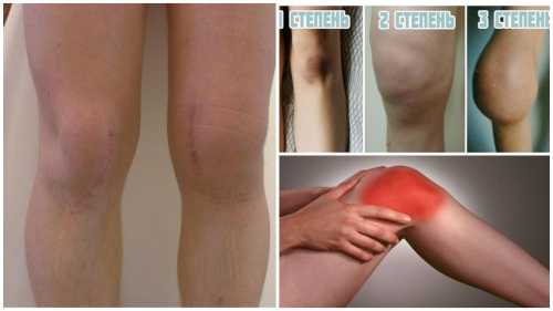 Гемартроз лучше всего лечить, если он впервые выявлен, тогда сроки лечения значительно сокращаются