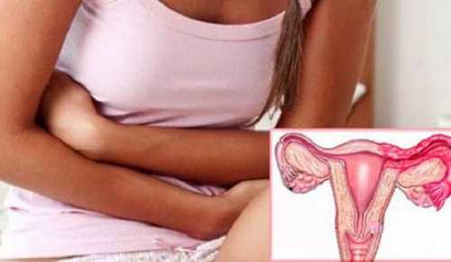 Воспаление придатков: симптомы, причины, это