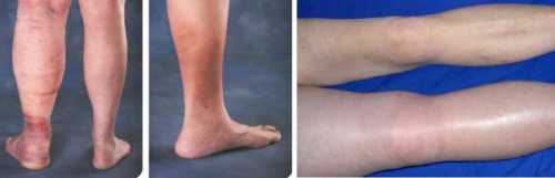 Чтобы правильно лечить тромбофлебит, независимо от того, в домашних условиях или в условиях стационара, диета должна быть максимально сбалансированной и питательной