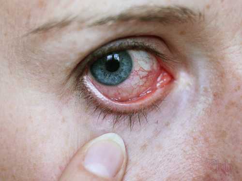 В первую очередь устраняют основное заболевание, также проводят симптоматическую терапию, направленную на купирование болезненных ощущений в глазах и приступов цефалгии