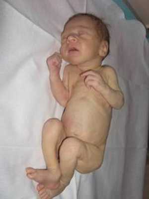 Гипотрофия у детей