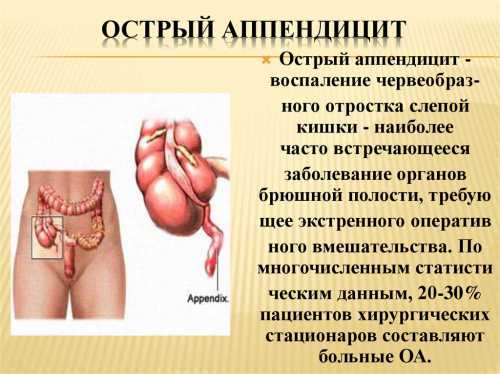 Воспаление аппендикса: симптомы, причины, это