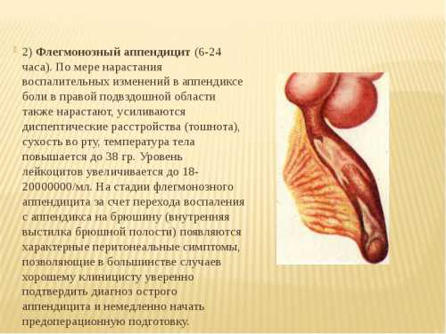 Обычно болезнь характеризуется острым течением, а потому симптоматические проявления интенсивные