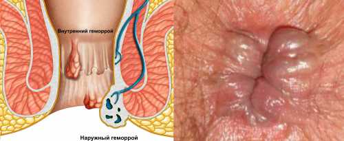 Как определить причины зуда в заднем проходе у