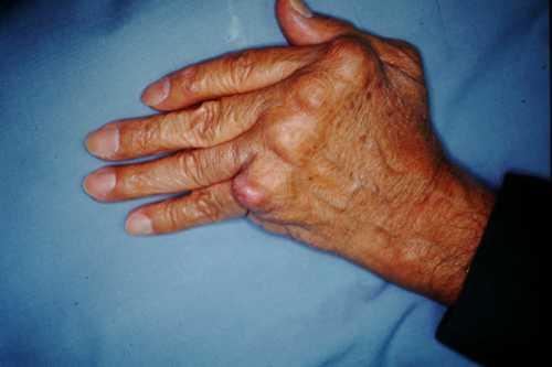 Основным источником являются стафилококковые и стрептококковые инфекции