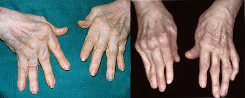 Ревматоидный полиартрит: симптомы, причины, это