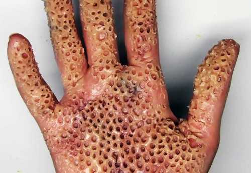 Боязнь дырок и отверстий