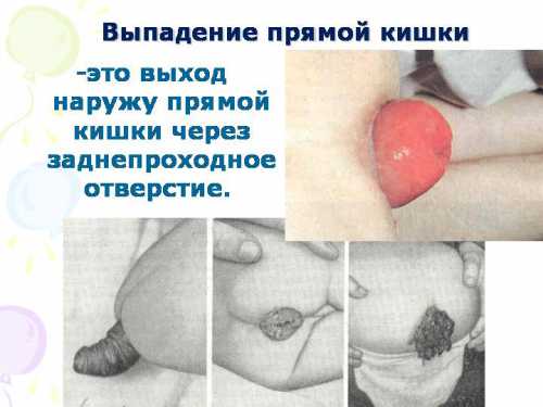 Часто ректальный пролапс является не самостоятельным заболеванием, а осложнением таких патологий, как понос, патологии мочеполовой системы, запоры, опухоли и полипы в толстой кишке