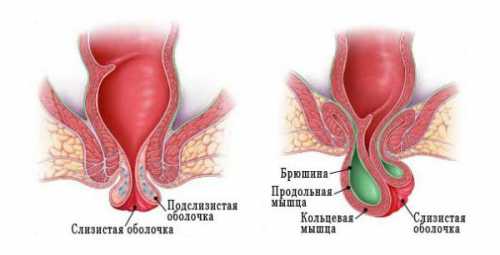 Лечение выпадения прямой кишки в домашних