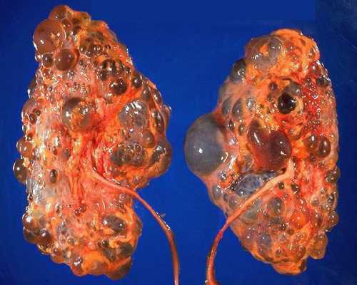 Такая процедура называется ретроградной интраренальной операцией