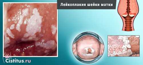 Симптомы болезни преимущественно отсутствуют