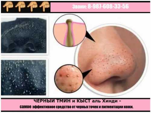 Как избавиться от чёрных точек