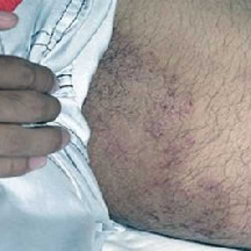 Защитный крем очень широко применяется крем в его состав входят оливковое масло, пантенол и оксид цинка