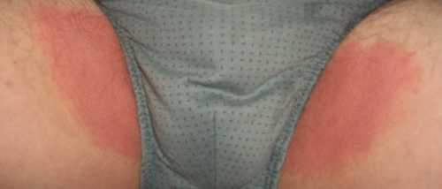 Женщины болеют реже данным заболеванием, в связи с тем, что они более тщательно соблюдают правила интимной личной гигиены