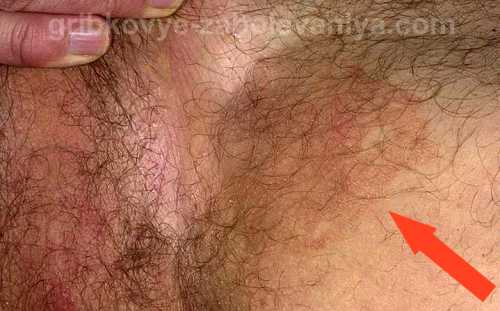 Опрелость в паху у женщин: симптомы, причины, это