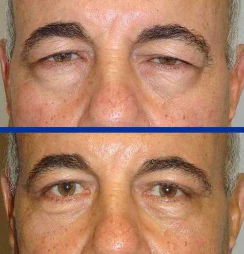 Невротический, то есть возникший вследствие причин нервного характера парезы, инсульты, неврит, рассеянный склероз