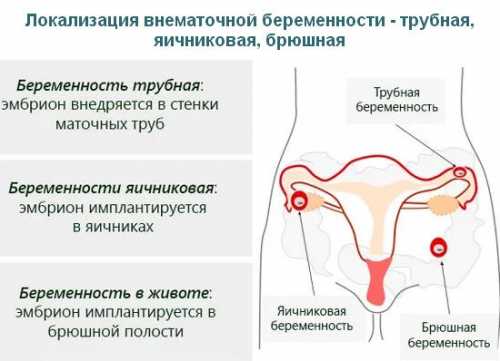 Как распознать внематочную беременность на ранних сроках