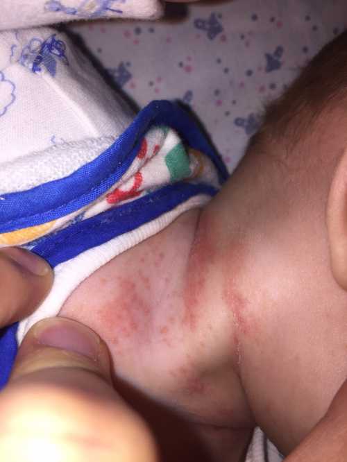 Детские опрелости