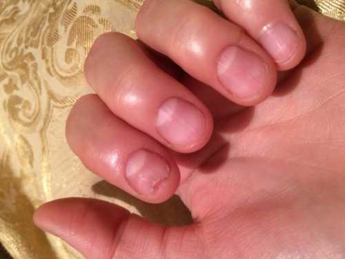 Заболевание ногтей на ногах может проявляться изолированно, только на ногтевой пластине, но в большинстве случаев одновременно поражается волосяной покров и кожа человека