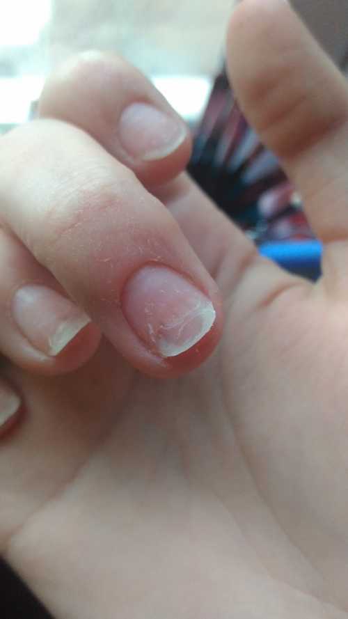 Патологический процесс начинается со свободного конца ногтевой пластины, проявляется в виде полосок и пятен желтой окраски