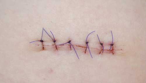 Кстати, если был косметический шов, то используют полипропилен, который снимают на день, либо викрилмонокрил, который не требует снятия, так как он рассасывается