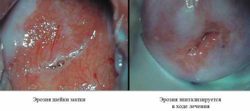 Крио деструкция