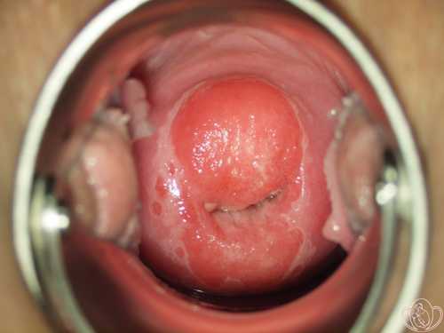 Основы лечения эрозии шейки матки народными