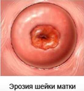 К недостаткам способа лечения можно отнести обильные слизистые выделения после процедуры риск укорочения шеечного канала лечить можно только незначительные по размеру образования отсутствие возможности контролировать глубину воздействия